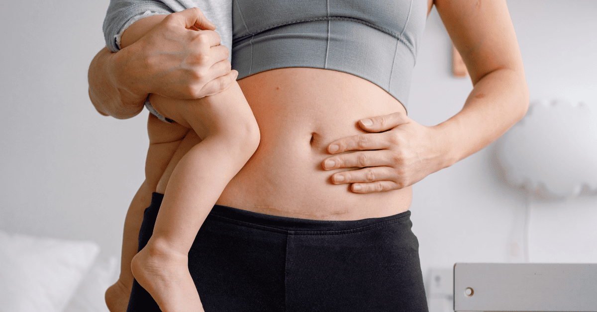 Caesarean section recovery; everything you need to know!