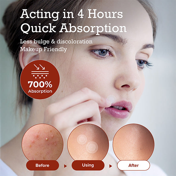 Pimple Lab Invisible Hydrocolloid Spot Patch / Pimple Patch (110 Patches)